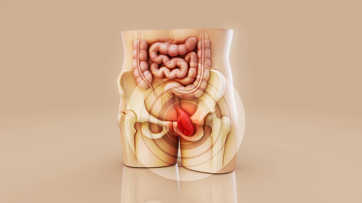 3D medical illustration of the pelvis and intestines with the affected area highlighted