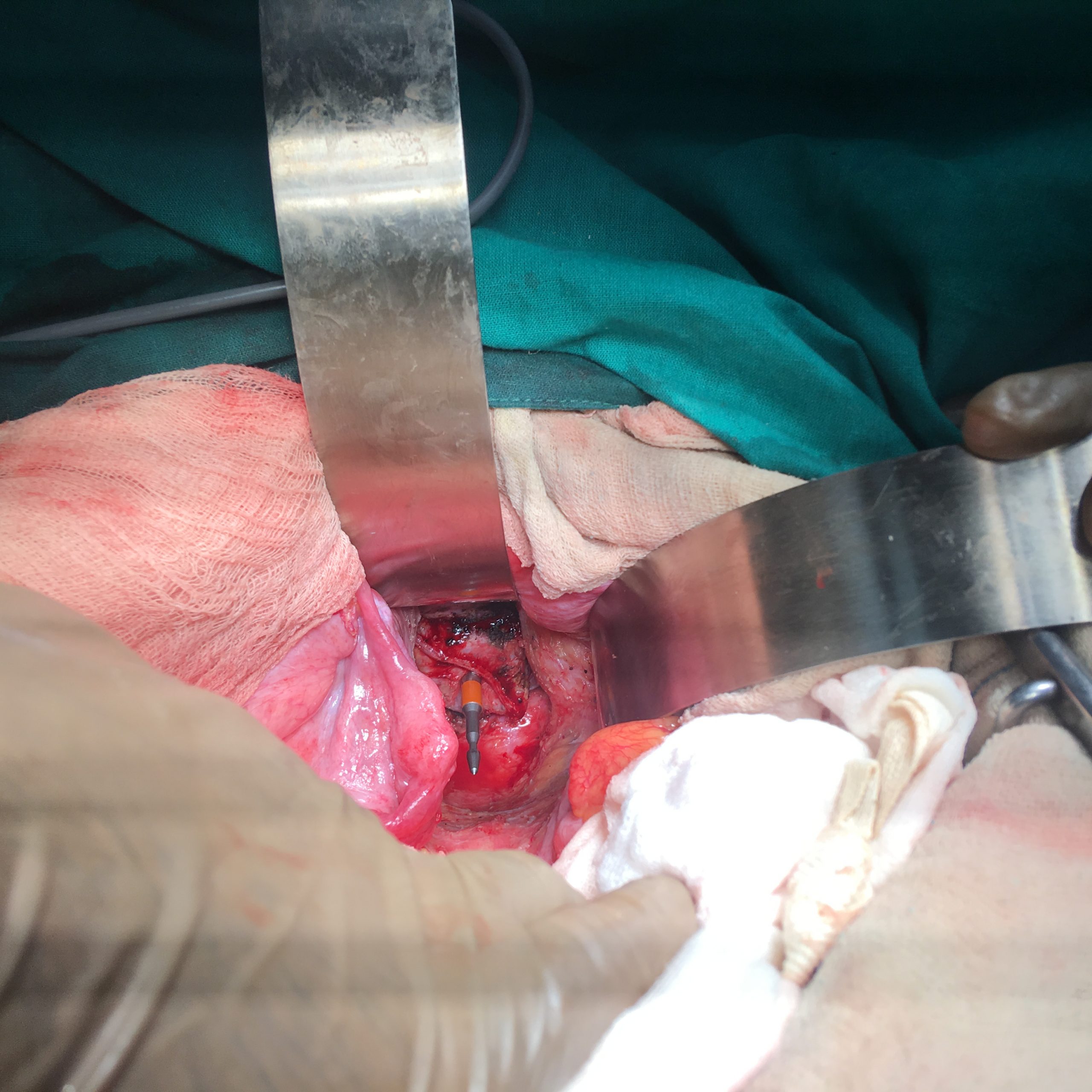 Stapled Anastomosis - Rectal Cancer Surgery