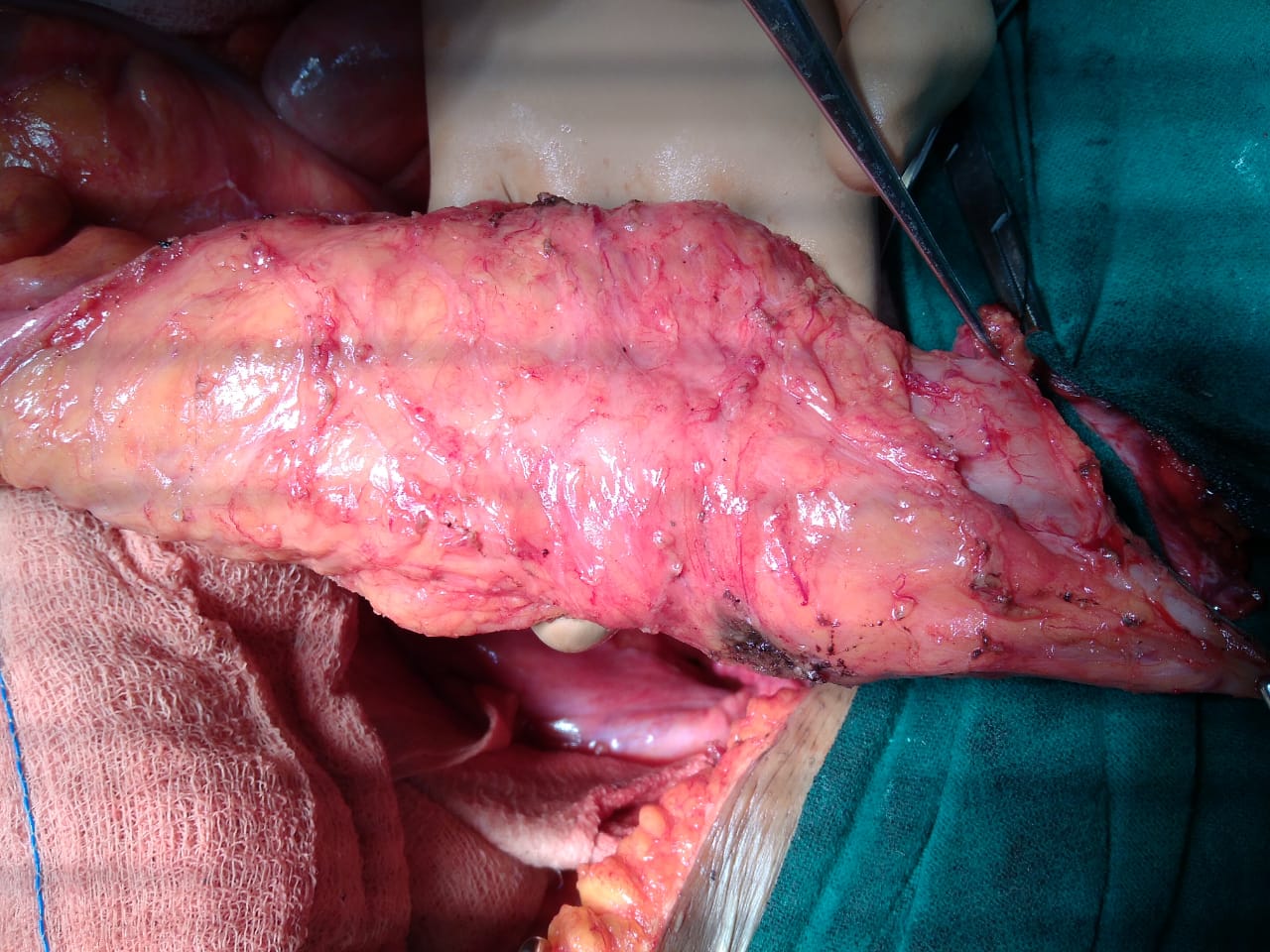 Total Mesorectal Excision for Middle-Third Rectal Cancer