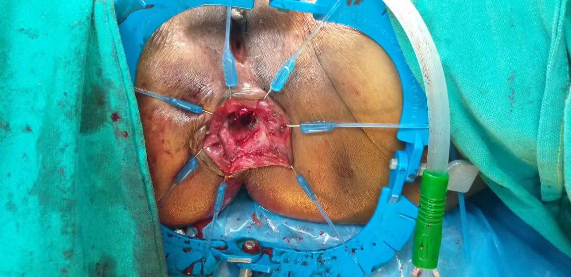 Intersphincteric Resection for Low Rectal Cancer