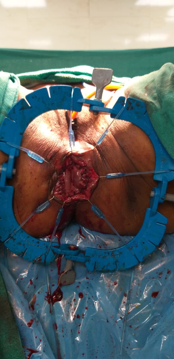 Reconstruction - Colo-Anal Anastomosis After Intersphincteric Resection
