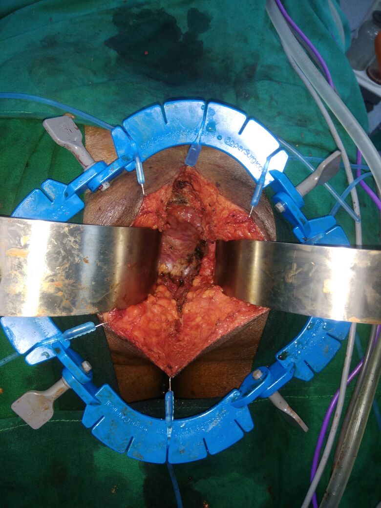 Extralevator Abdominoperineal Resection for Low Rectal Cancer