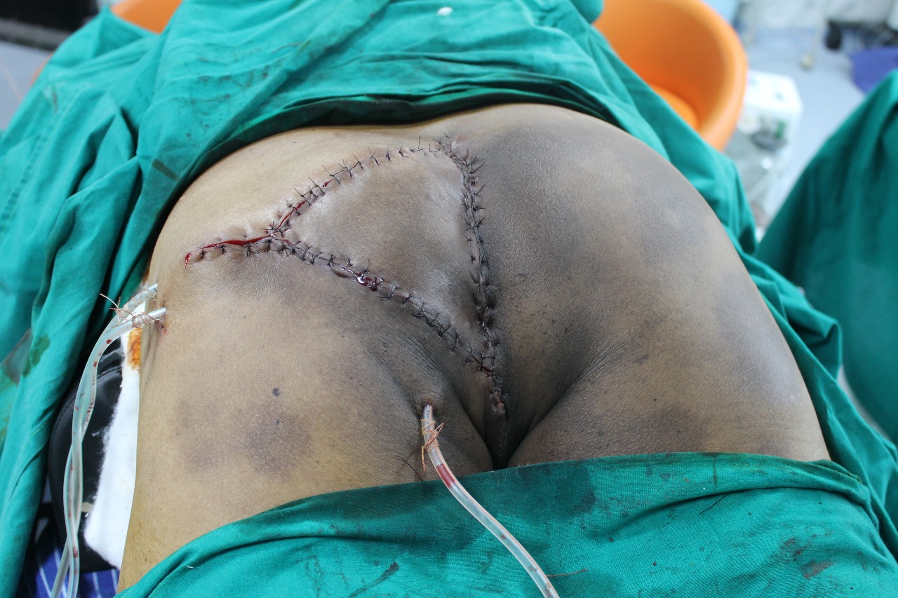 Extralevator Abdominoperineal Resection - After Reconstruction