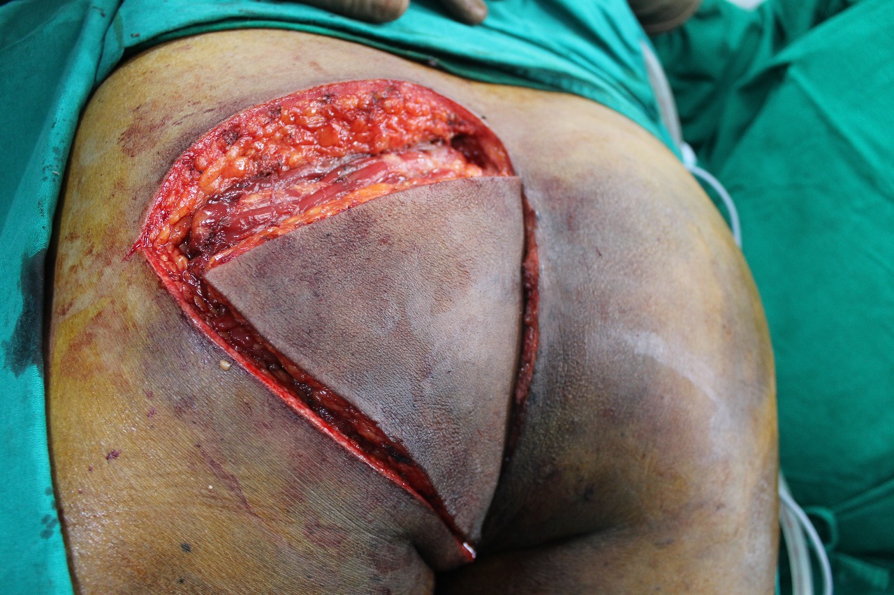 Myocutaneous Flap for Extralevator Abdominoperineal Resection