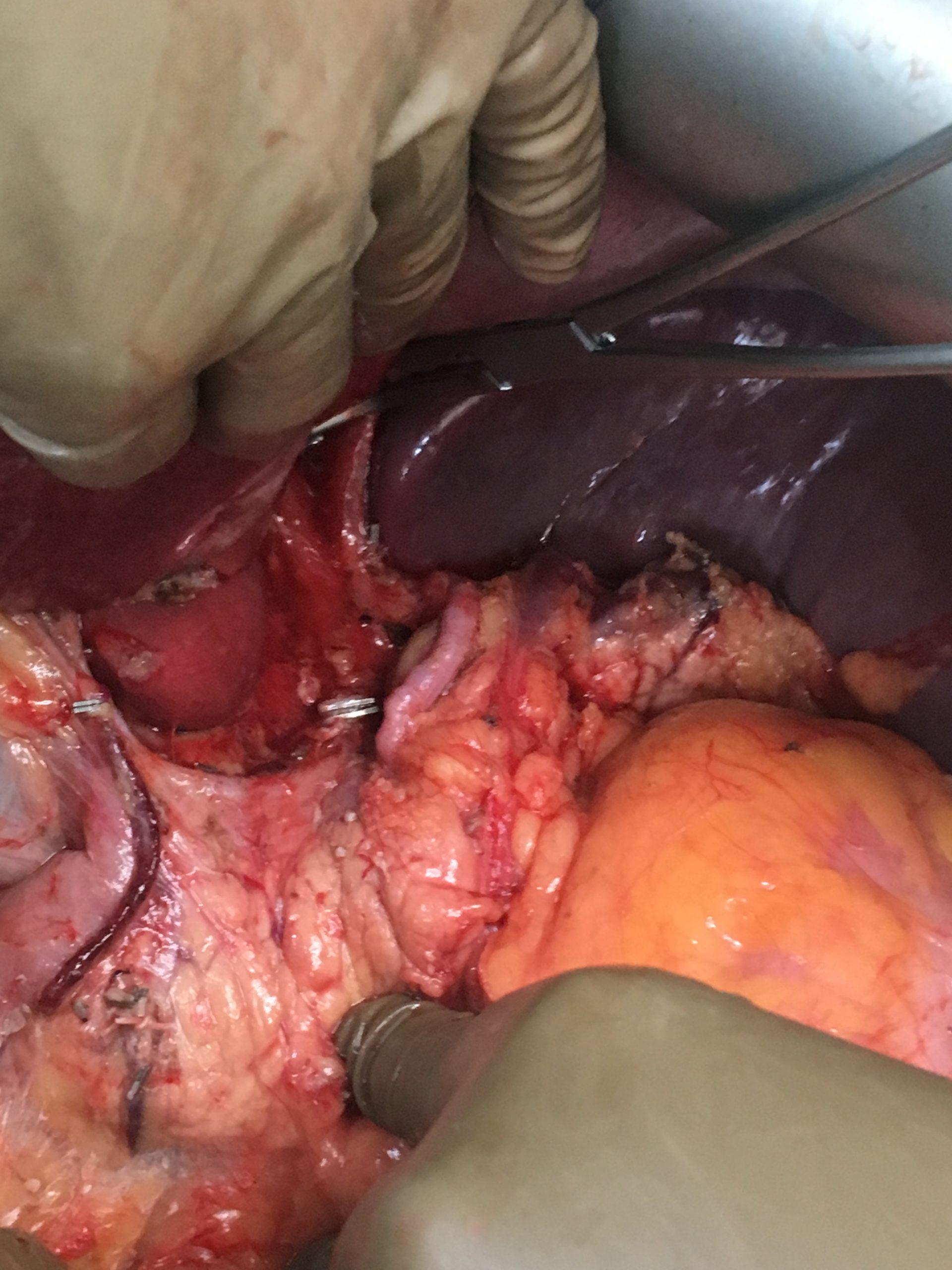 Radical D2 Gastrectomy for Neuroendocrine Tumour of Stomach