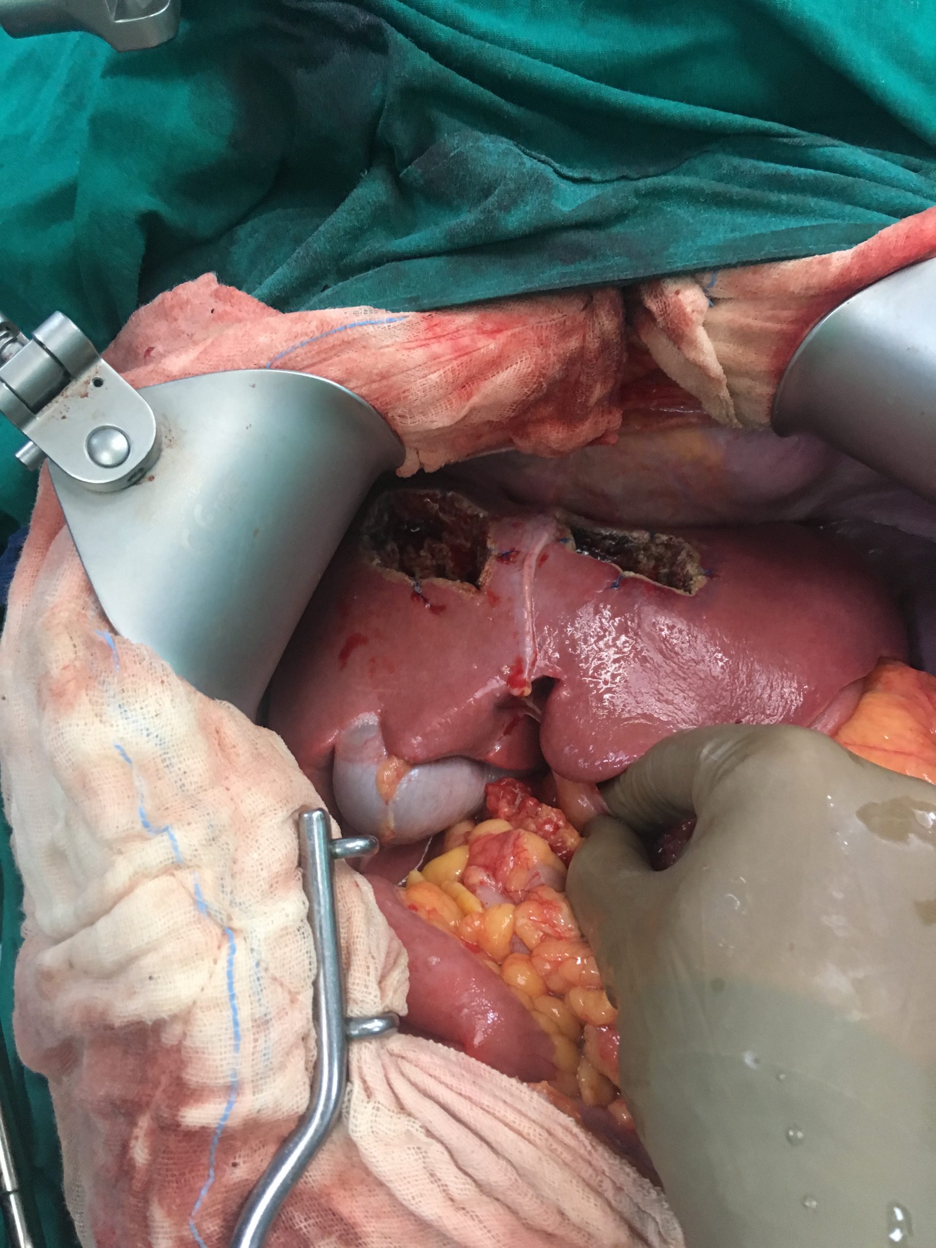 Removal of Liver Metastases for Neuroendocrine Tumour