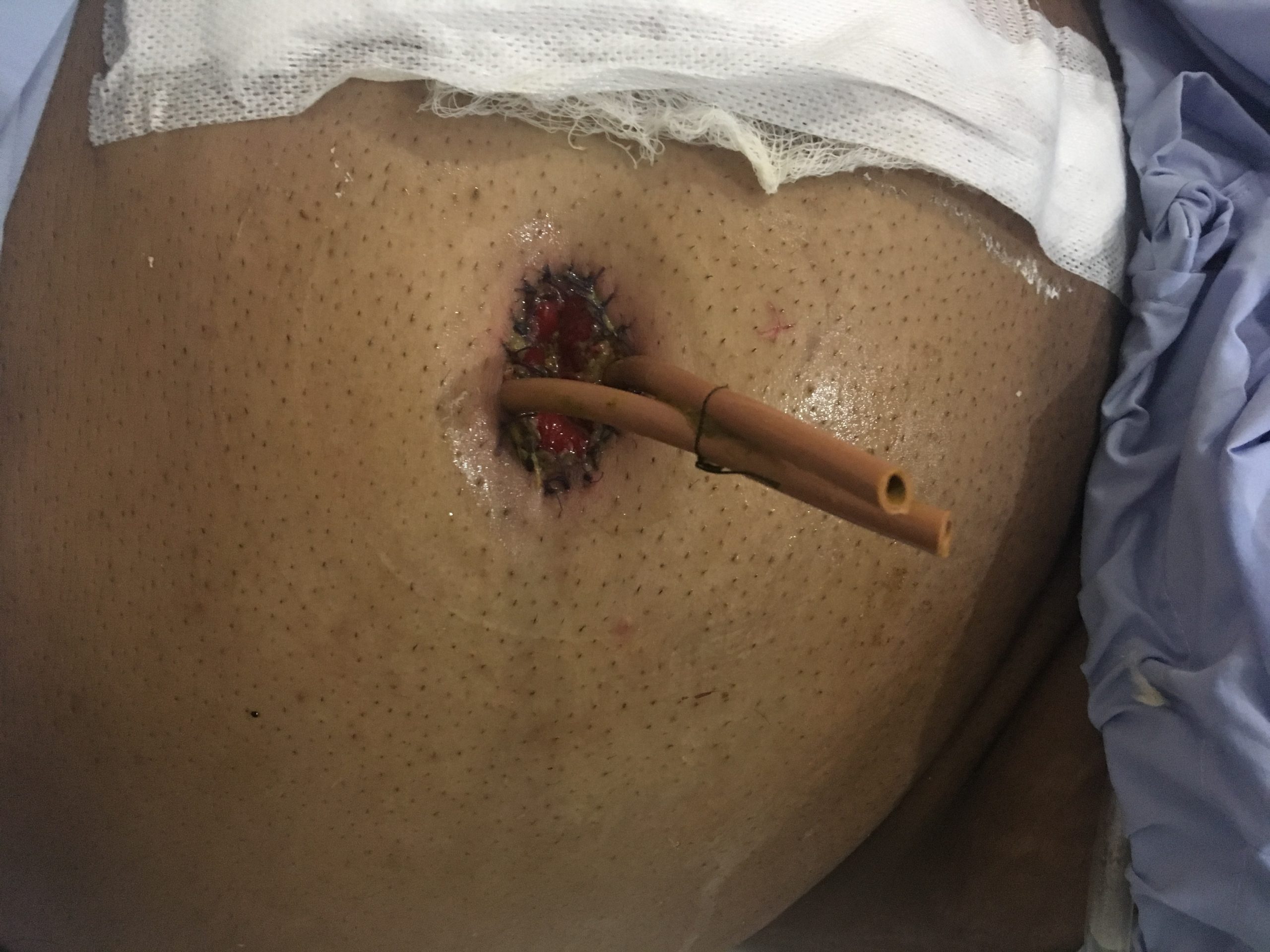 Colostomy