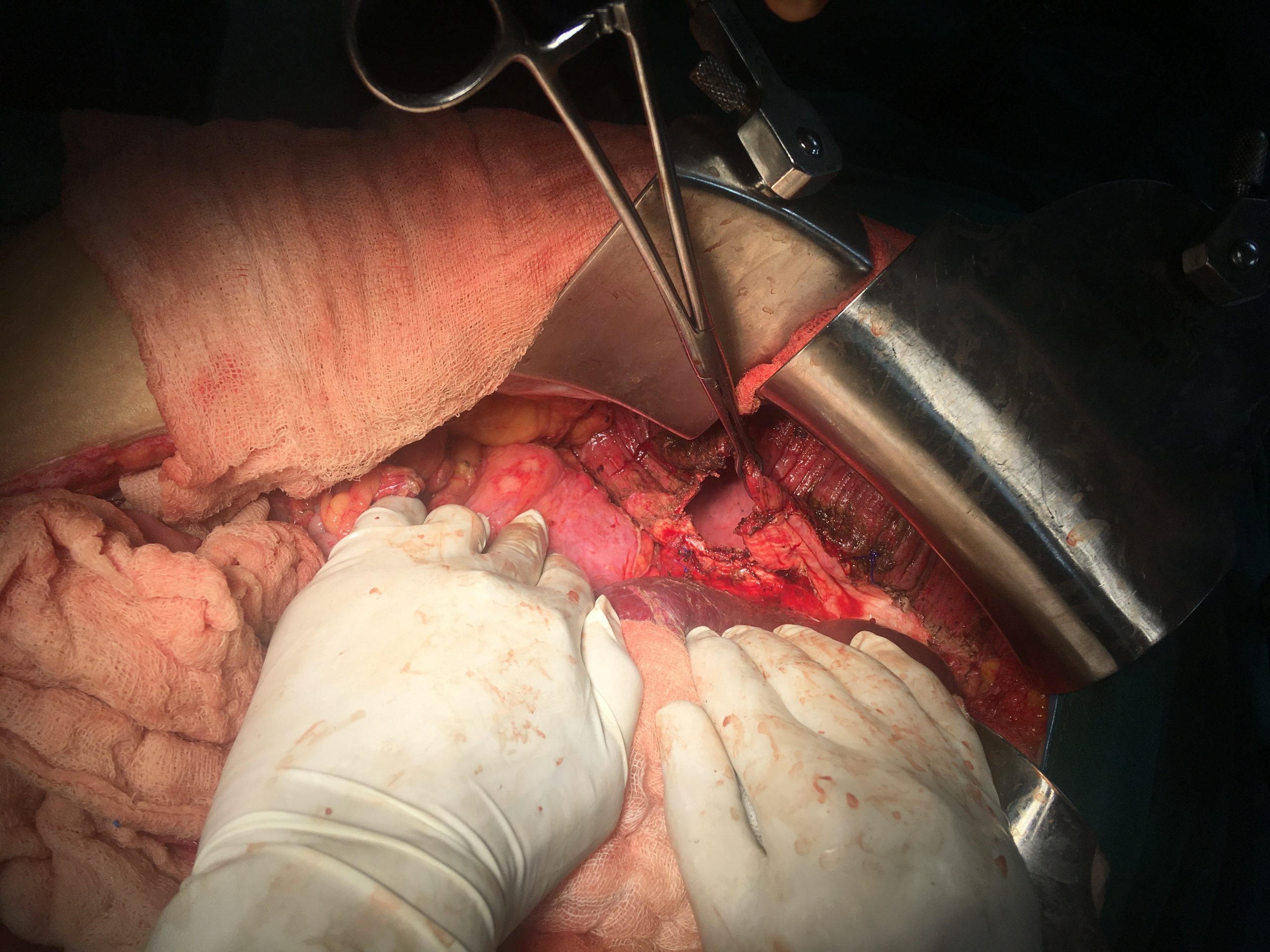 Peritonectomy with Diaphragmatic Resection for Ovarian Cancer
