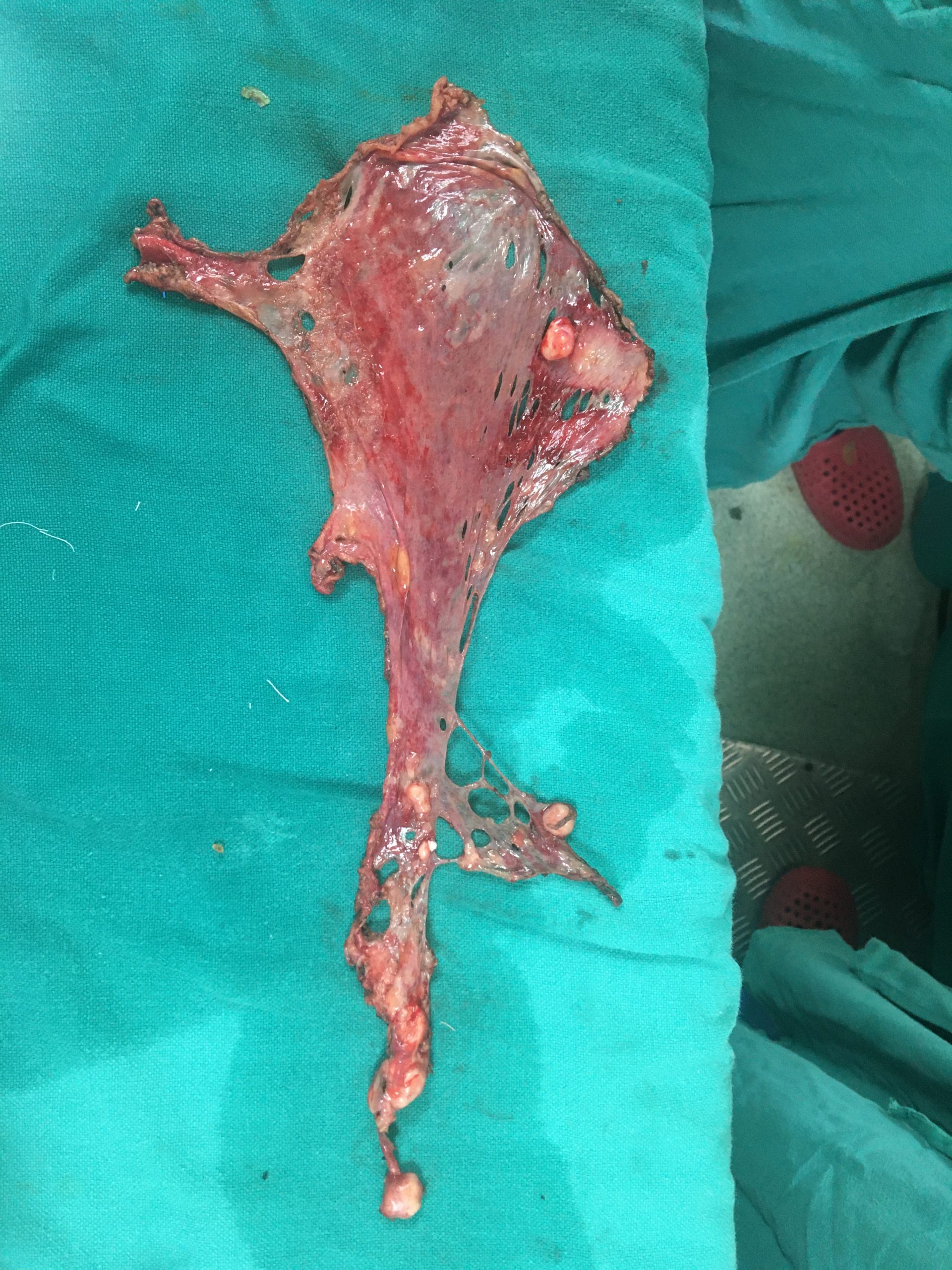Peritonectomy Specimen