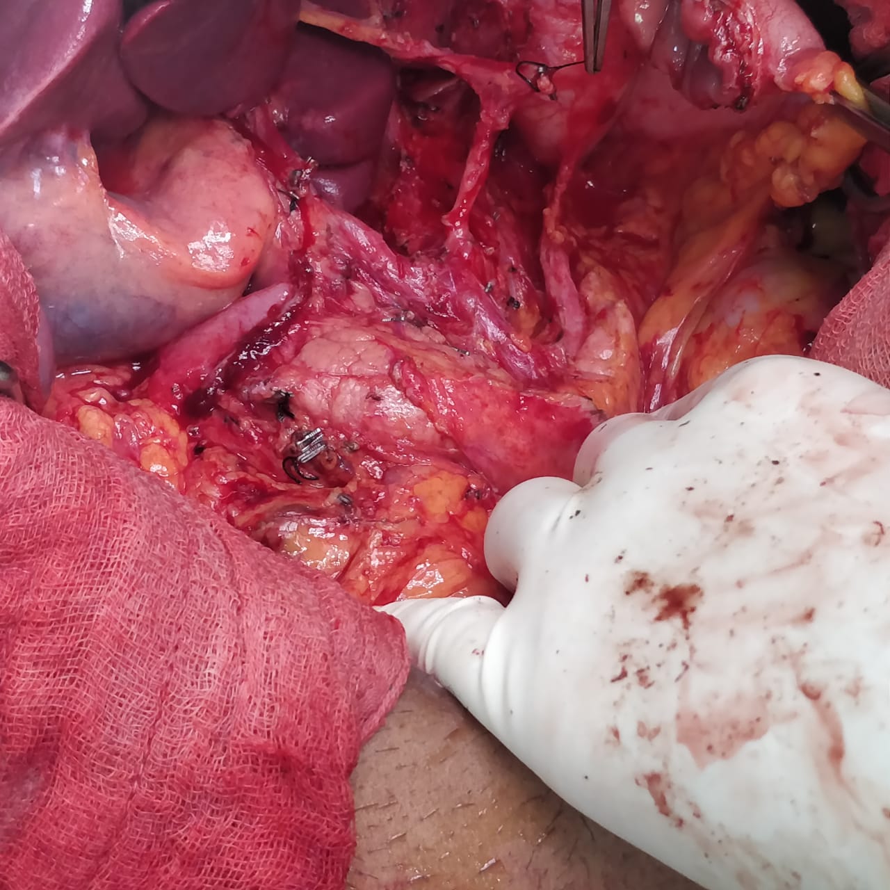 D2 Gastrectomy - Radical Gastric Cancer Surgery