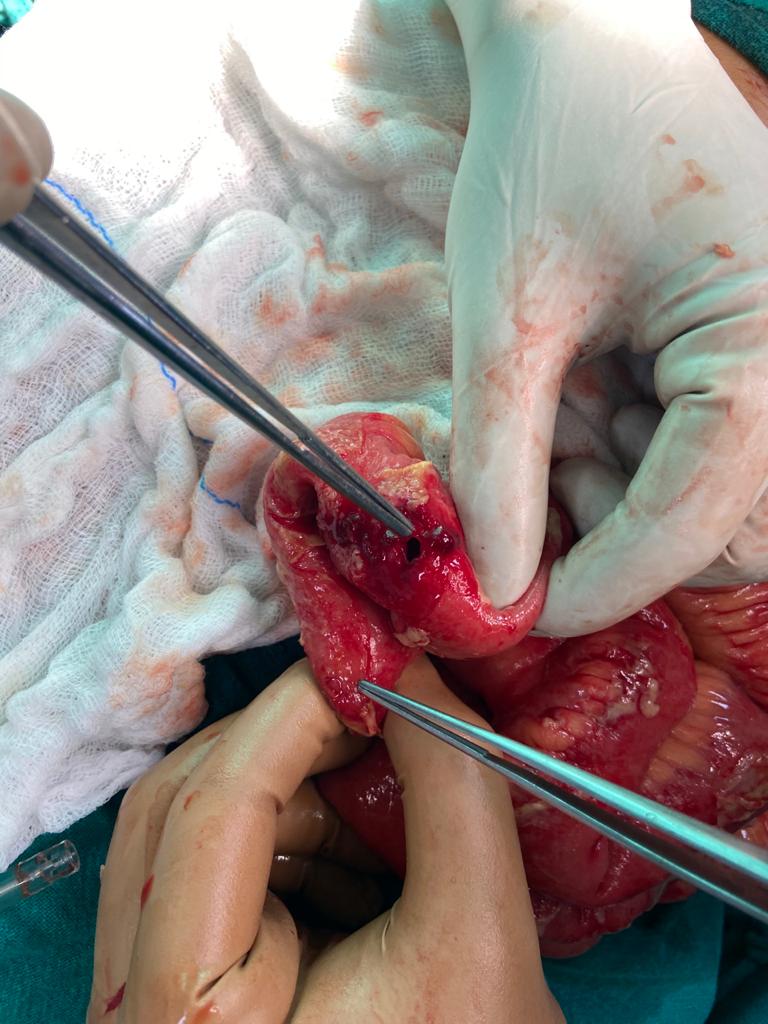 Emergency Surgery for Ileal Perforation