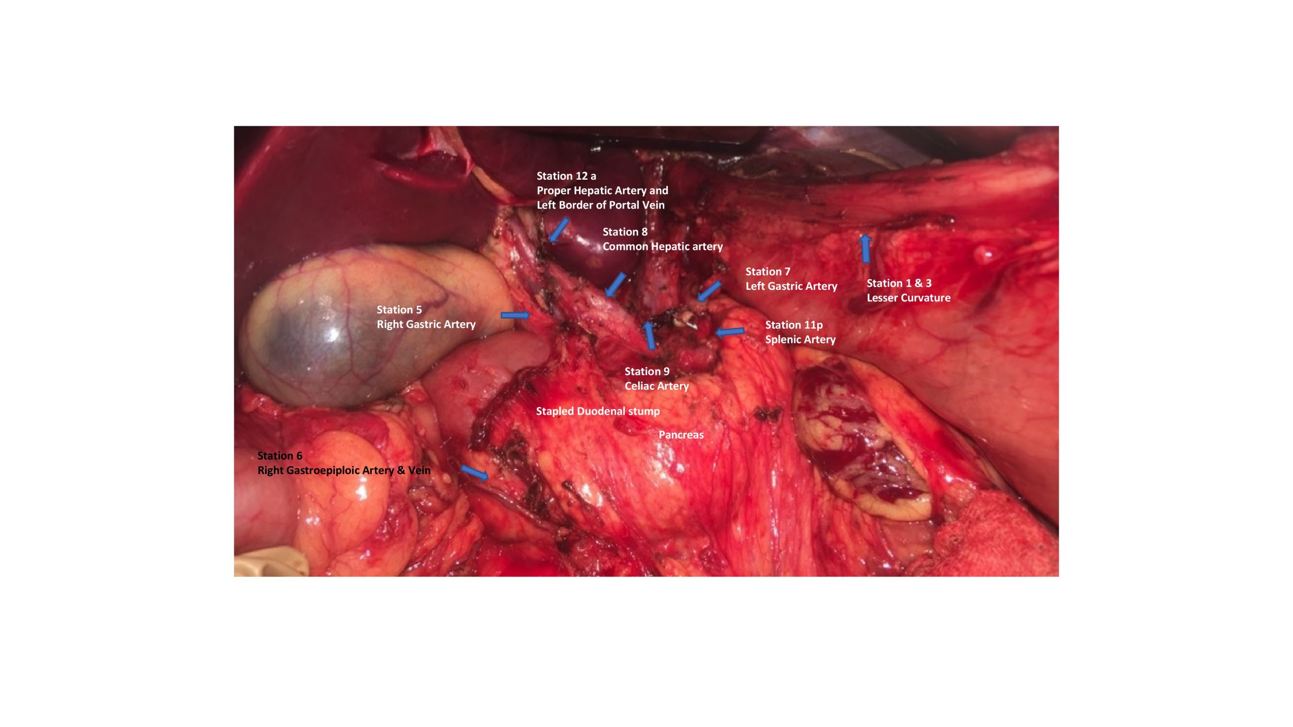 Subtotal D2 Gastrectomy
