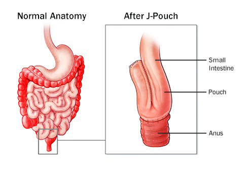 Special Concerns for People with J-Pouches