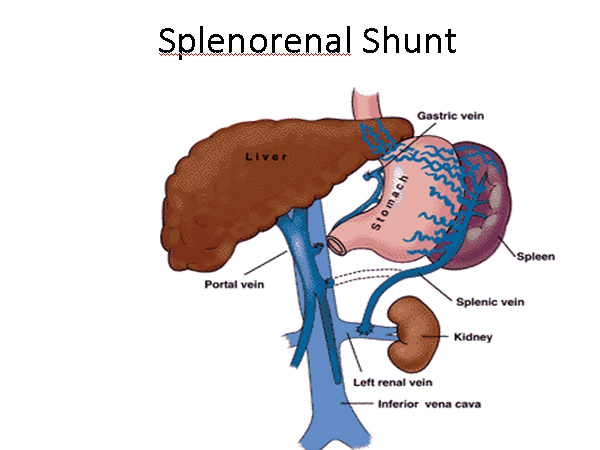 splenorenal shunt